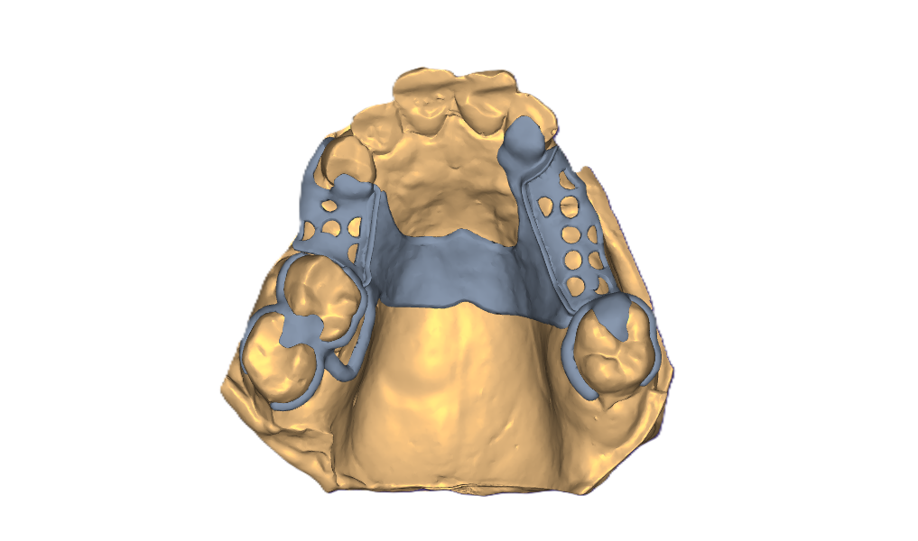 Removable Prosthodontics